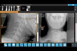 IQ-4VIEW Cervical Curve Screenshot