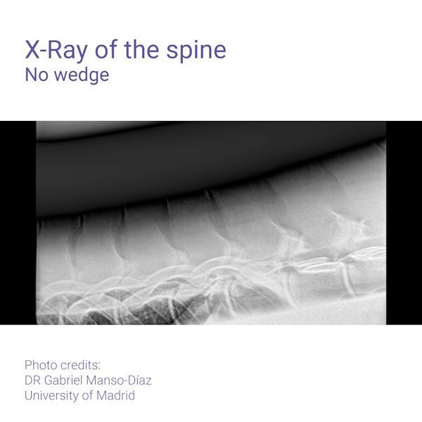 Podoblock Aluminium Wedge