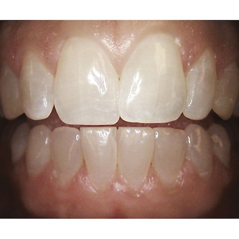 Carestream Dental CS1500 Wired USB Intraoral Camera