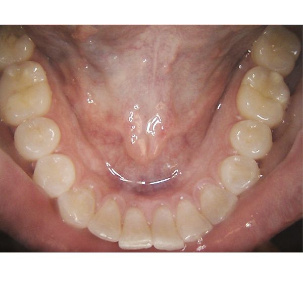 Carestream Dental CS1500 Wired USB Intraoral Camera