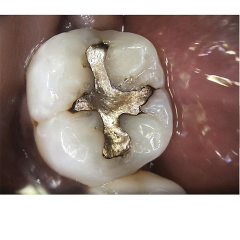 Carestream Dental CS1500 Wired USB Intraoral Camera