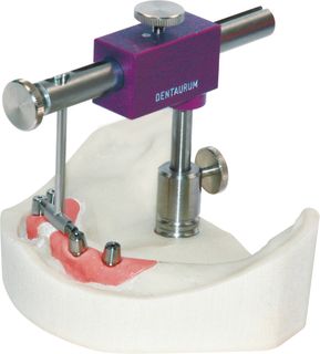 Paralas For Parallel Fixation