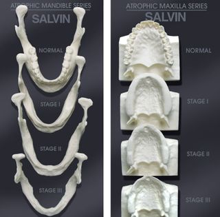 BONE LOSS MODEL SET