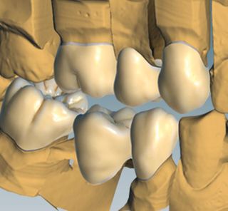 CERAMILL TRUE SMILE UPGRADE