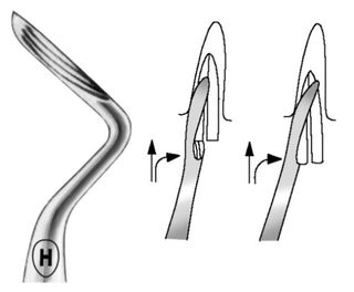 ROOT ELEVATOR LOWER KOPP FIG 6