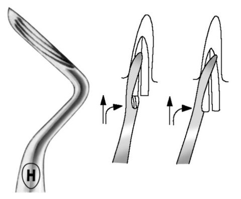 ROOT ELEVATOR LOWER KOPP FIG 6