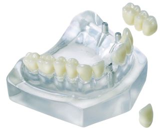 MODEL 3 UNIT BRIDGE/2 IMPLANT & 1 CROWN