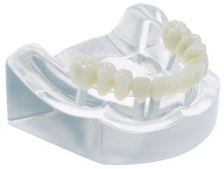 MODEL 6 IMPLANT BRIDGE