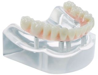 MODEL 6 IMPLANT HIGH WATER BRIDGE