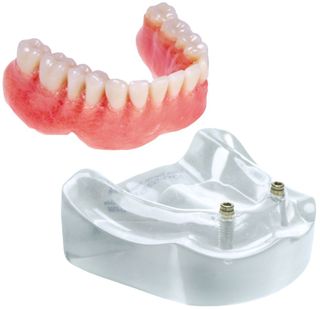 MODEL 2 IMPLANT LOCATOR LOWER OVERDENTURE