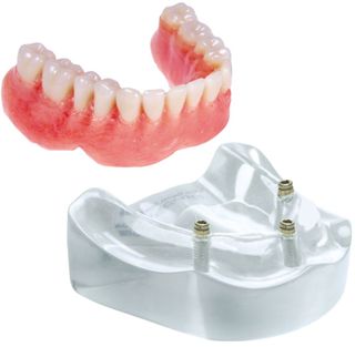 MODEL 3 IMPLANT LOCATOR LOWER OVERDENTURE