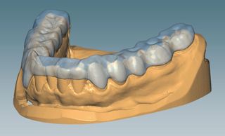 CERAMILL M SPLINT