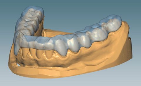 CERAMILL M SPLINT