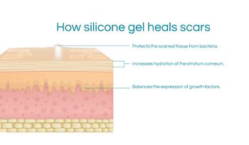 How NewGel+ can help scar contracture after surgery and burns.